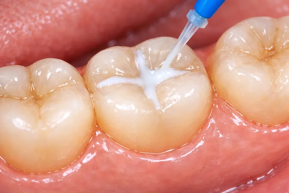 odontologia general – segellat dental